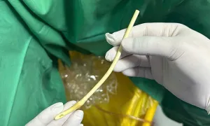 Cụ ông tự cắt đứt ống thông tiểu khiến dây tụt vào bàng quang